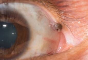 视网膜脱落需要做哪些检查