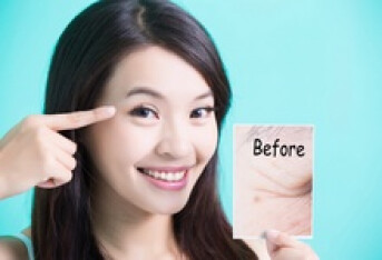 祛痘都要注意什么？护肤达人告诉你，快速祛痘没烦恼 