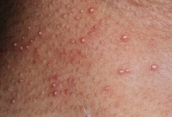 治皮肤瘙痒的药有哪些？
