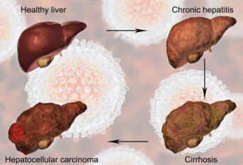 解密肝炎与肝癌的关系