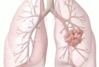 肺癌的病因有哪些？这5点应重视