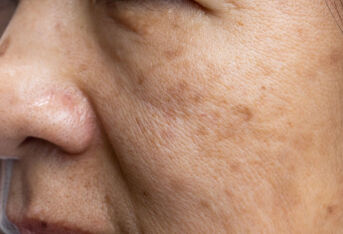 女人脸上长斑可能是哪些疾病的前兆？