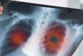 得了肺癌的身体会出现哪些征兆？
