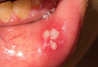 年轻女子口腔溃疡反复发作，后被诊断为癌症的原因