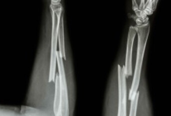桡骨远端骨折严重吗 桡骨远端骨折的几个严重症状详述