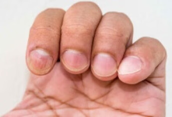 手指甲真菌感染症状及治疗方法有哪些