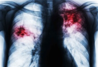 肺大疱有什么症状 肺大疱易出现气胸情况