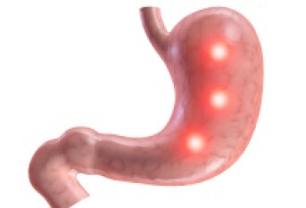 怎么会有胃溃疡 探寻导致胃溃疡3个病因