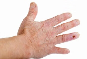 治疗手指关节风湿偏方 民间什么秘方可以治疗风湿