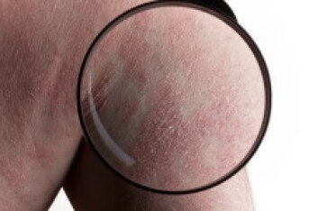 湿疹皮炎用什么药最好 如何防止皮肤病发作