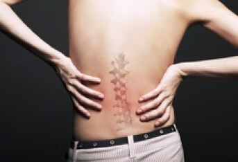 筋膜炎和腰肌劳损区别 腰痛就是腰肌劳损吗