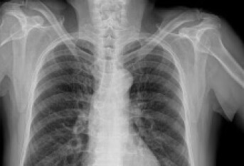肺结核导致的胸腔积液怎么办