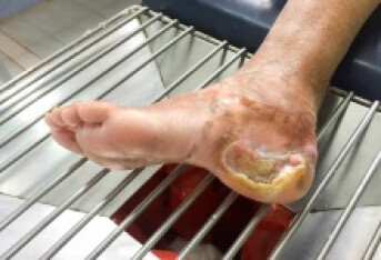糖尿病足三期能治好吗 如何治疗三期糖尿病足