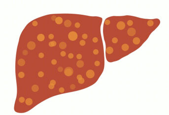 老年人做B超查出来脂肪肝，应该怎么去除脂肪肝？