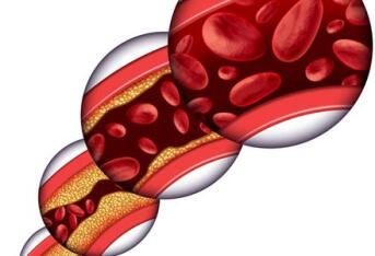 脉络膜新生血管应该做哪些检查？