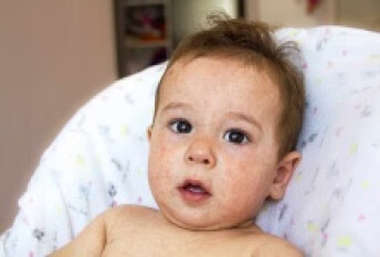 宝宝身上脸上起红斑都是什么疾病引起呢