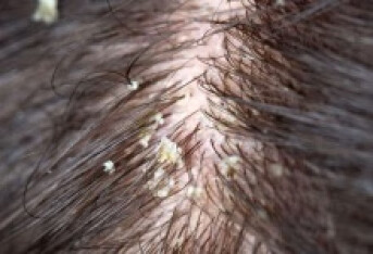 脂溢性脱发可以彻底治愈吗 脂溢性脱发治愈率介绍