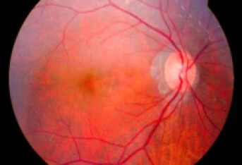 多灶性脉络膜视网膜炎是葡萄膜炎吗