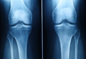 膝关节退行性改变怎么治