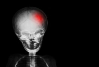 重型颅脑损伤可以恢复吗 4个方法助重型颅脑损伤恢复