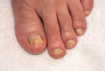 美甲可能是导致各种灰指甲的病因
