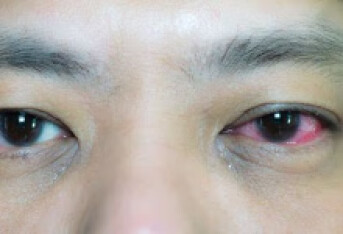 眼球震颤的原因有哪些 眼球震颤的四个原因复杂