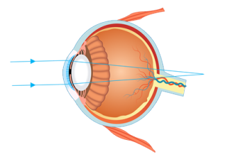 红眼病患者滥用抗生素会导致视力下降