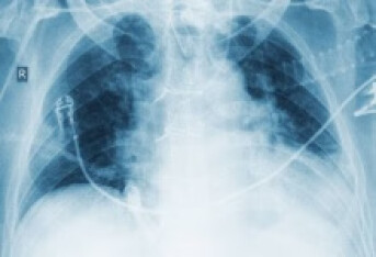 支气管扩张初期症状有哪些 支气管扩张初期四个症状突出