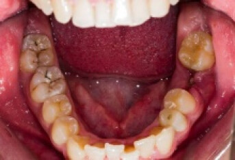 牙龈炎会导致口腔炎么 牙龈炎会导致五个"恶果"