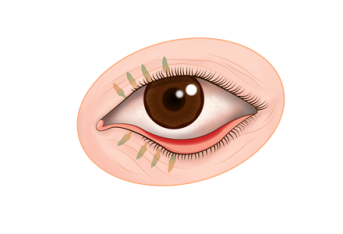 眼睛经常痒可能是过敏体质