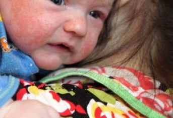 婴儿湿疹怎么快速有效止痒 ？