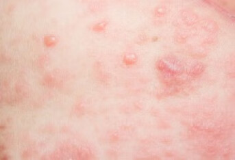 荨麻疹为什么在秋冬季容易复发呢