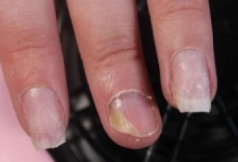 灰指甲是真菌感染引起的吗  揭秘灰指甲的发病原因