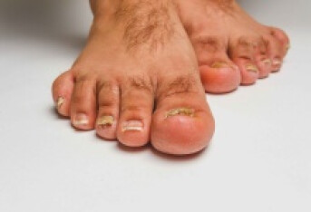 脚上灰指甲怎么治疗 三招助你治疗脚灰指甲