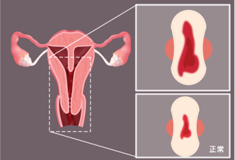 子宫肌瘤的高危病因介绍 子宫肌瘤的常见原因有哪些