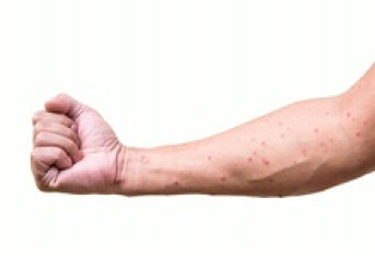 冬季儿童需留心 接种疫苗可防水痘