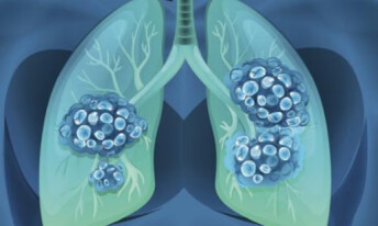 肺癌化疗到底是怎么回事？