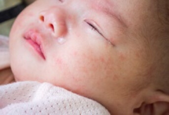 婴儿湿疹常用什么药