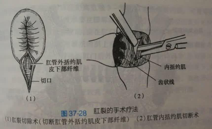 拉屎剧痛,肛裂了怎么办?-京东健康