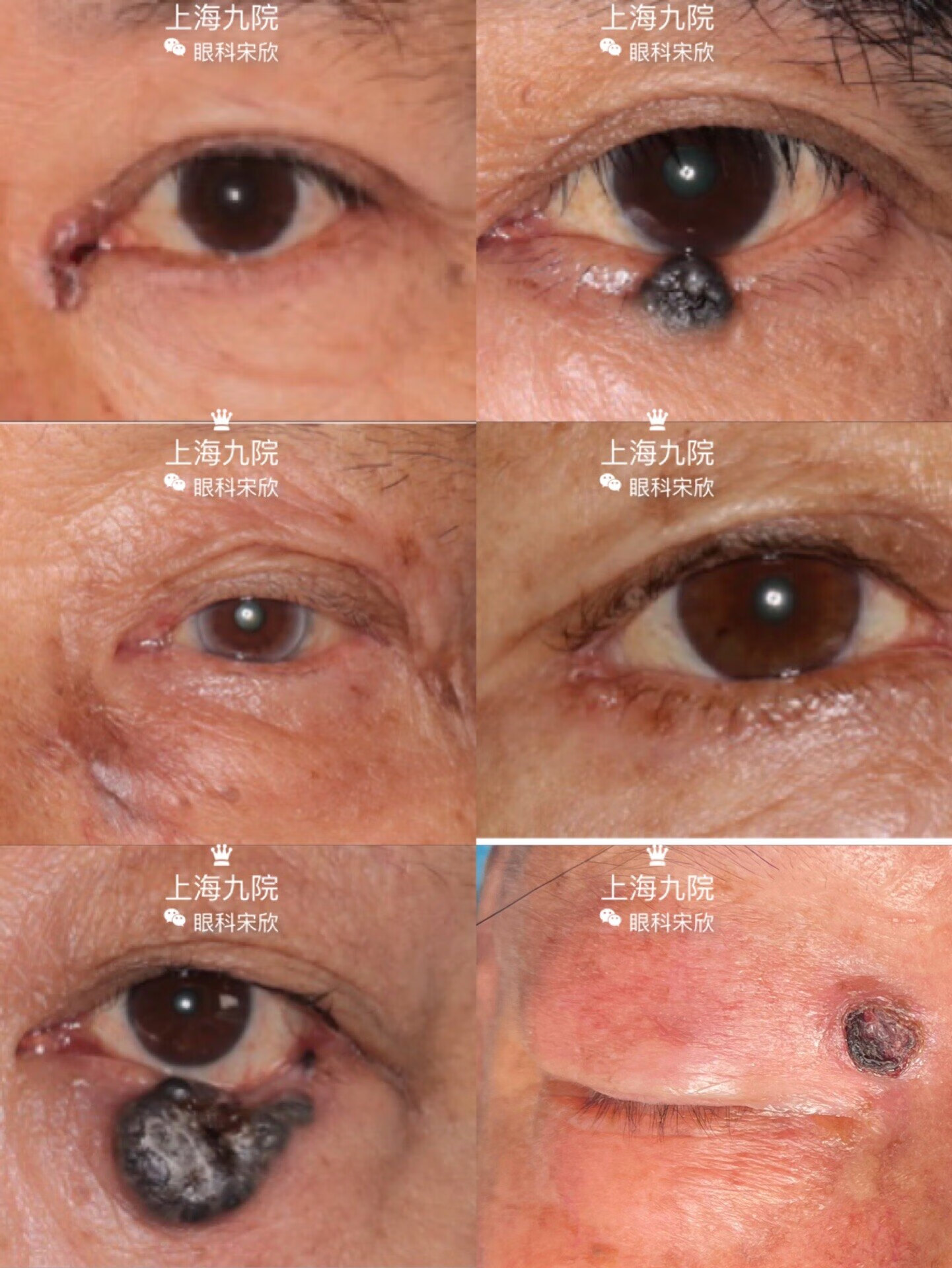 图1-7 鳞屑性眼睑炎-眼前节疾病-医学