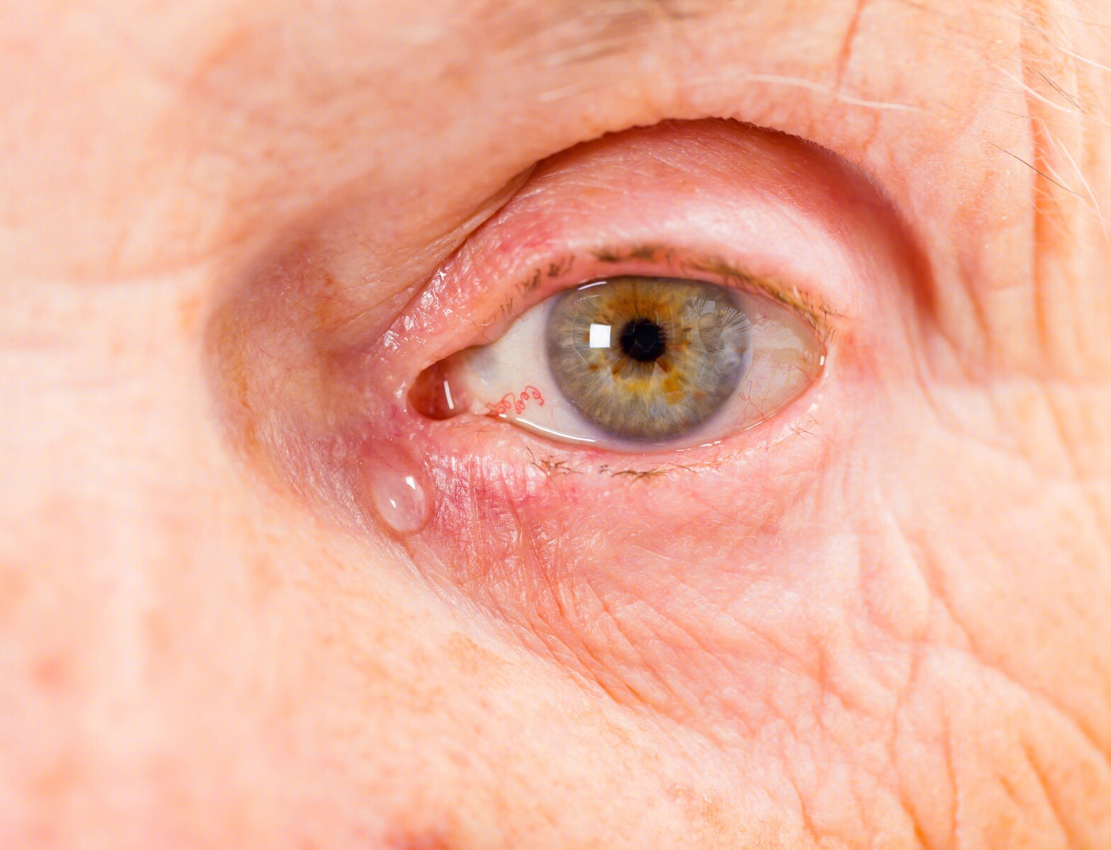 角膜擦伤和角膜异物（眼里有异物）-眼外伤 - 知乎