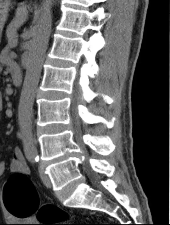 腰椎间盘突出微创脊柱内镜术后经常会遇见那些问题 概述 骨科