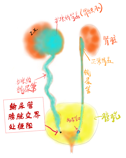 2 肾积水的分类