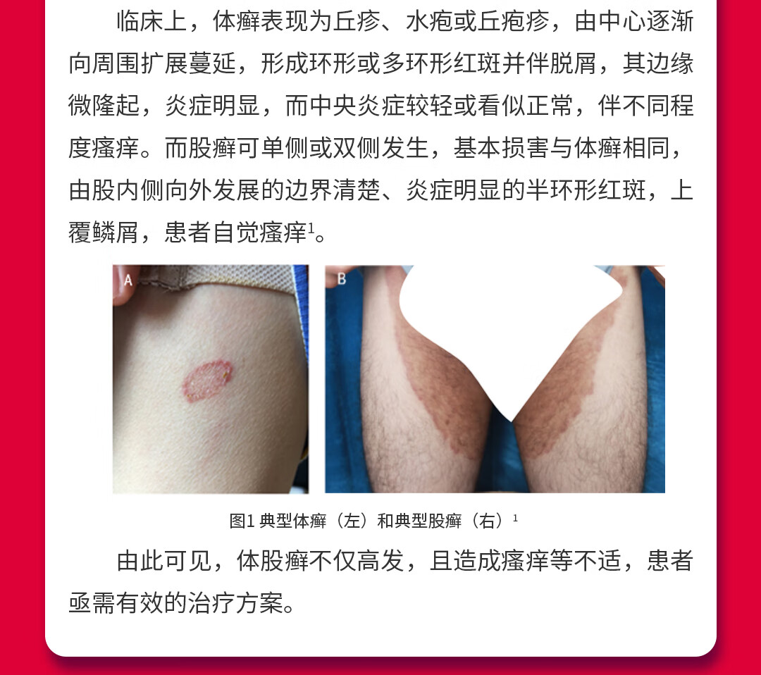 2.28酮康唑直播回顾3