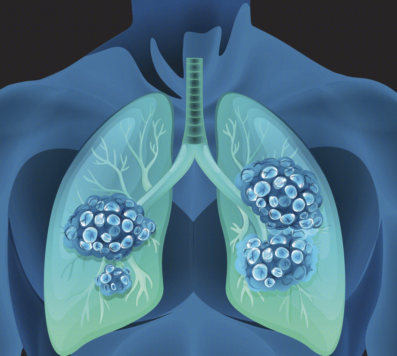支气管哮喘的图片大全-支气管哮喘的高清图片下载-觅知网