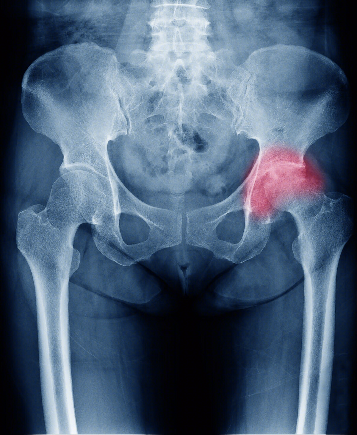 一文掌握丨股骨转子间骨折：并发症分析及防治|并发症|股骨头|髋内翻|螺钉|-健康界