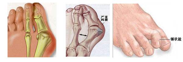 脚趾变形,周围还长老茧,我的脚到底是怎么了?-京东健康