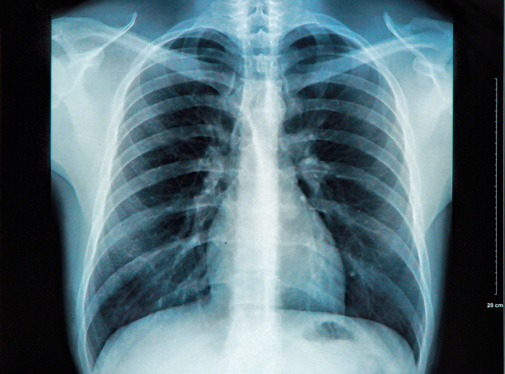 关于肺癌，你想知道的都在这里|吸烟者|切除术|胸外科|肺癌|肿瘤|风险|手术|肺部|疾病|-健康界
