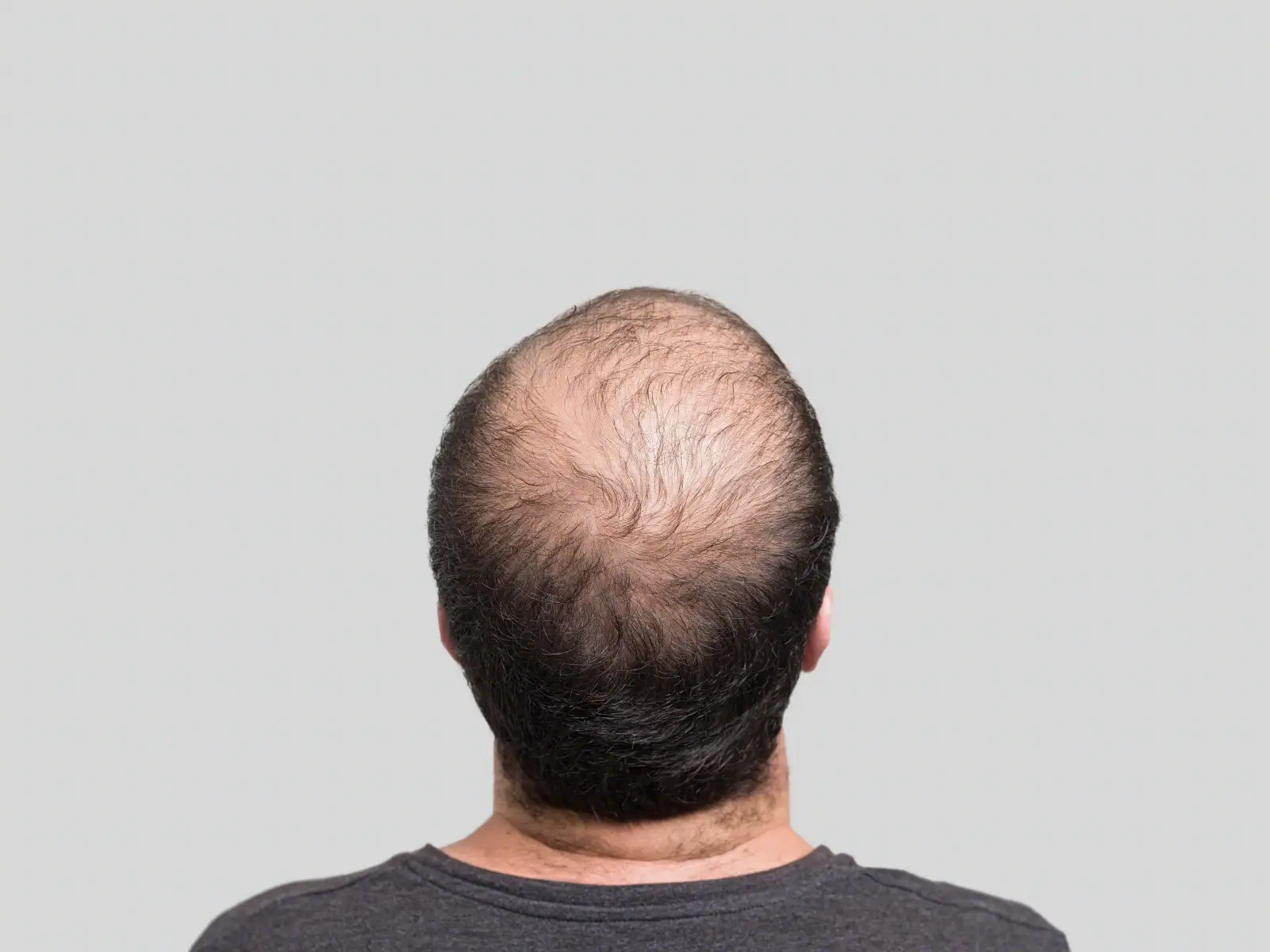 大多数男性在35岁后出现脱发 脱发与癌症有关吗 男性健康 病因 肿瘤科 护发 皮肤科