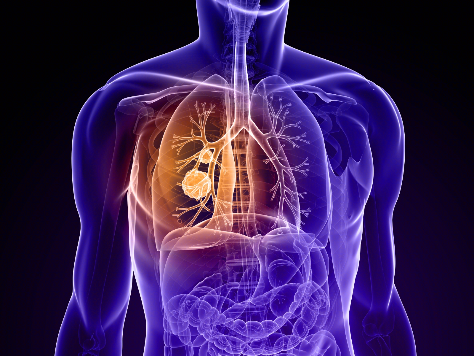 有肺结节就是癌？90%的肺结节都不是癌！ |肺结节|直径|手术|肺癌|体检|-健康界